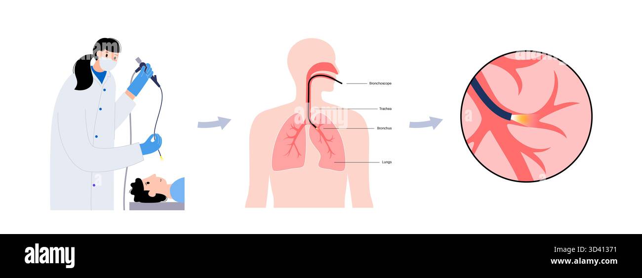Illustrazione di una procedura broncoscopica. Ciò comporta l'inserimento di un tubo lungo, sottile e flessibile chiamato broncoscopio attraverso il naso o la bocca per esaminare il tubo del vento e le vie aeree. Viene utilizzato per diagnosticare le condizioni polmonari fornendo una visione chiara del rivestimento polmonare e consentire il prelievo di campioni di tessuto o fluido per analisi di laboratorio. Foto Stock