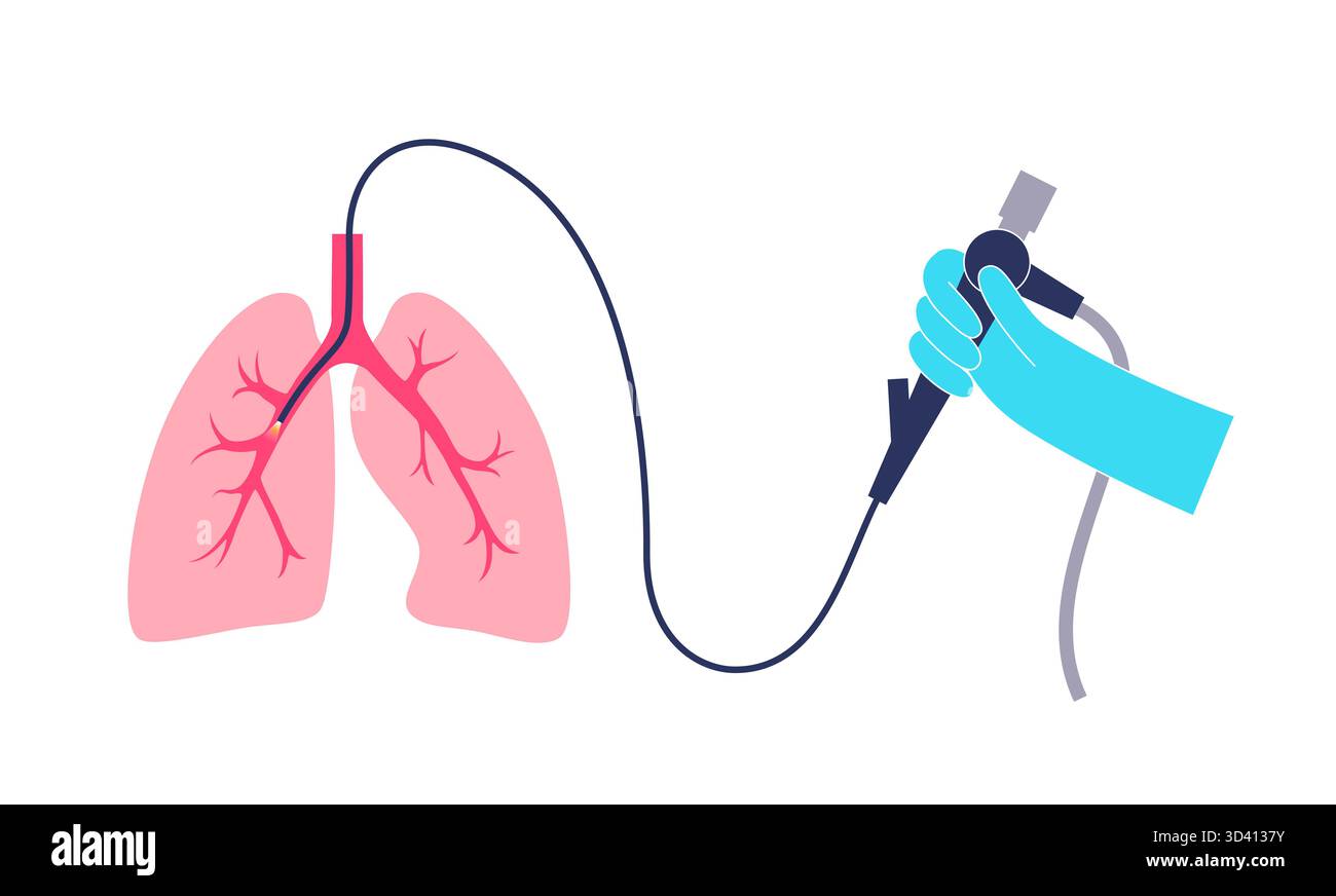 Illustrazione di una procedura broncoscopica. Ciò comporta l'inserimento di un tubo lungo, sottile e flessibile chiamato broncoscopio attraverso il naso o la bocca per esaminare il tubo del vento e le vie aeree. Viene utilizzato per diagnosticare le condizioni polmonari fornendo una visione chiara del rivestimento polmonare e consentire il prelievo di campioni di tessuto o fluido per analisi di laboratorio. Foto Stock