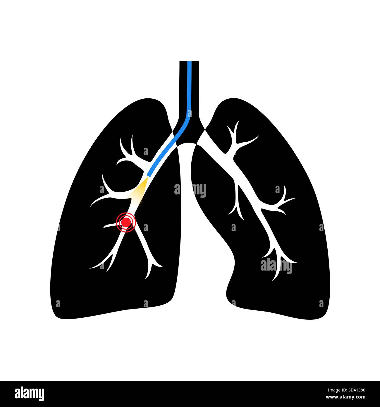Illustrazione di una procedura broncoscopica. Ciò comporta l'inserimento di un tubo lungo, sottile e flessibile chiamato broncoscopio attraverso il naso o la bocca per esaminare il tubo del vento e le vie aeree. Viene utilizzato per diagnosticare le condizioni polmonari fornendo una visione chiara del rivestimento polmonare e consentire il prelievo di campioni di tessuto o fluido per analisi di laboratorio. Foto Stock