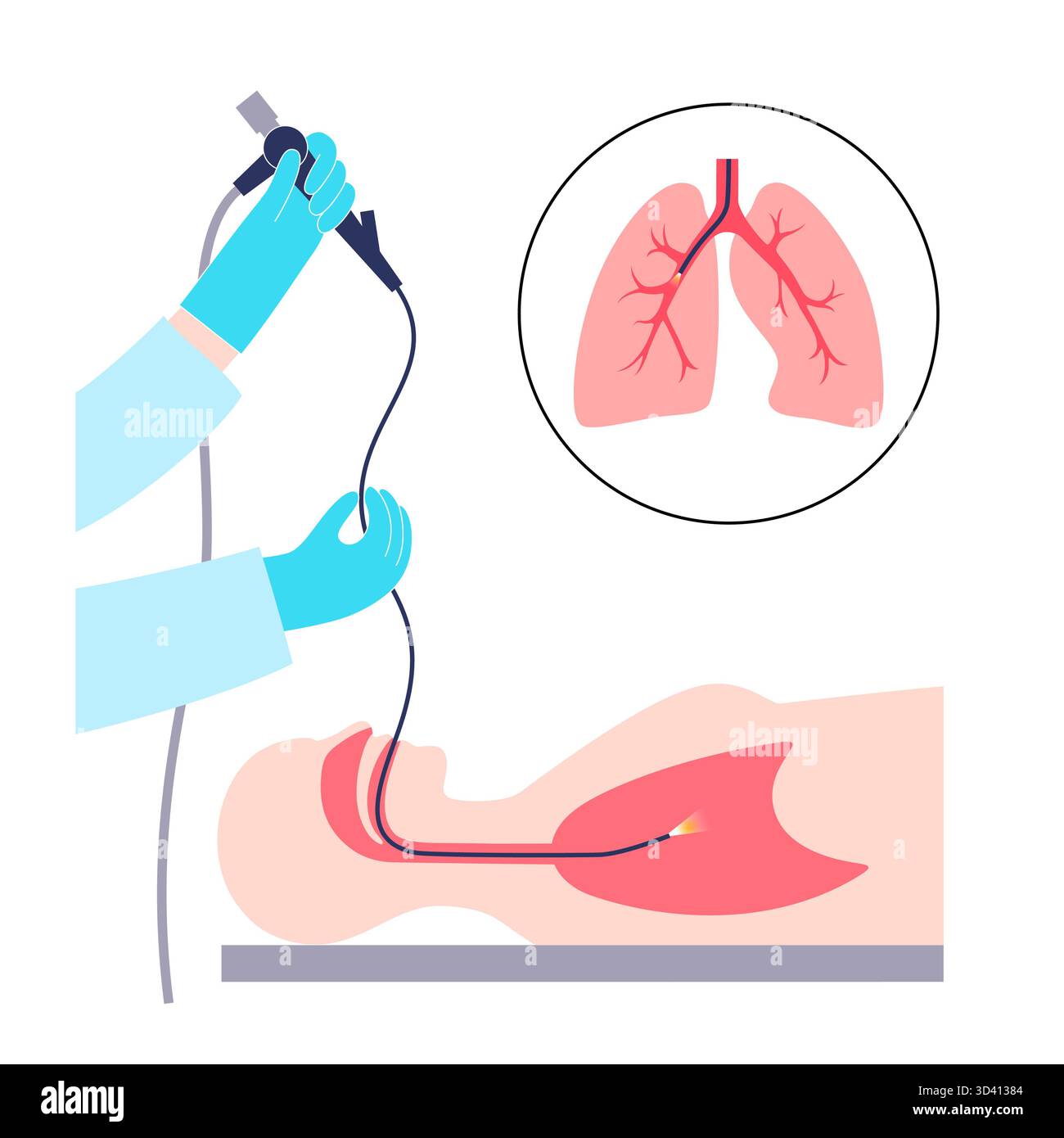 Illustrazione di una procedura broncoscopica. Ciò comporta l'inserimento di un tubo lungo, sottile e flessibile chiamato broncoscopio attraverso il naso o la bocca per esaminare il tubo del vento e le vie aeree. Viene utilizzato per diagnosticare le condizioni polmonari fornendo una visione chiara del rivestimento polmonare e consentire il prelievo di campioni di tessuto o fluido per analisi di laboratorio. Foto Stock