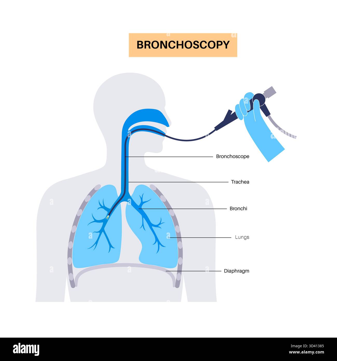 Illustrazione di una procedura broncoscopica. Ciò comporta l'inserimento di un tubo lungo, sottile e flessibile chiamato broncoscopio attraverso il naso o la bocca per esaminare il tubo del vento e le vie aeree. Viene utilizzato per diagnosticare le condizioni polmonari fornendo una visione chiara del rivestimento polmonare e consentire il prelievo di campioni di tessuto o fluido per analisi di laboratorio. Foto Stock