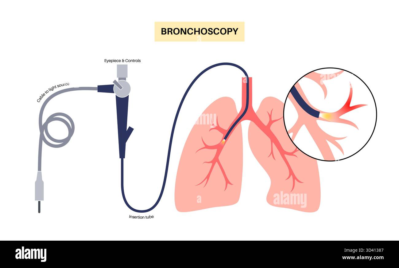 Illustrazione di una procedura broncoscopica. Ciò comporta l'inserimento di un tubo lungo, sottile e flessibile chiamato broncoscopio attraverso il naso o la bocca per esaminare il tubo del vento e le vie aeree. Viene utilizzato per diagnosticare le condizioni polmonari fornendo una visione chiara del rivestimento polmonare e consentire il prelievo di campioni di tessuto o fluido per analisi di laboratorio. Foto Stock