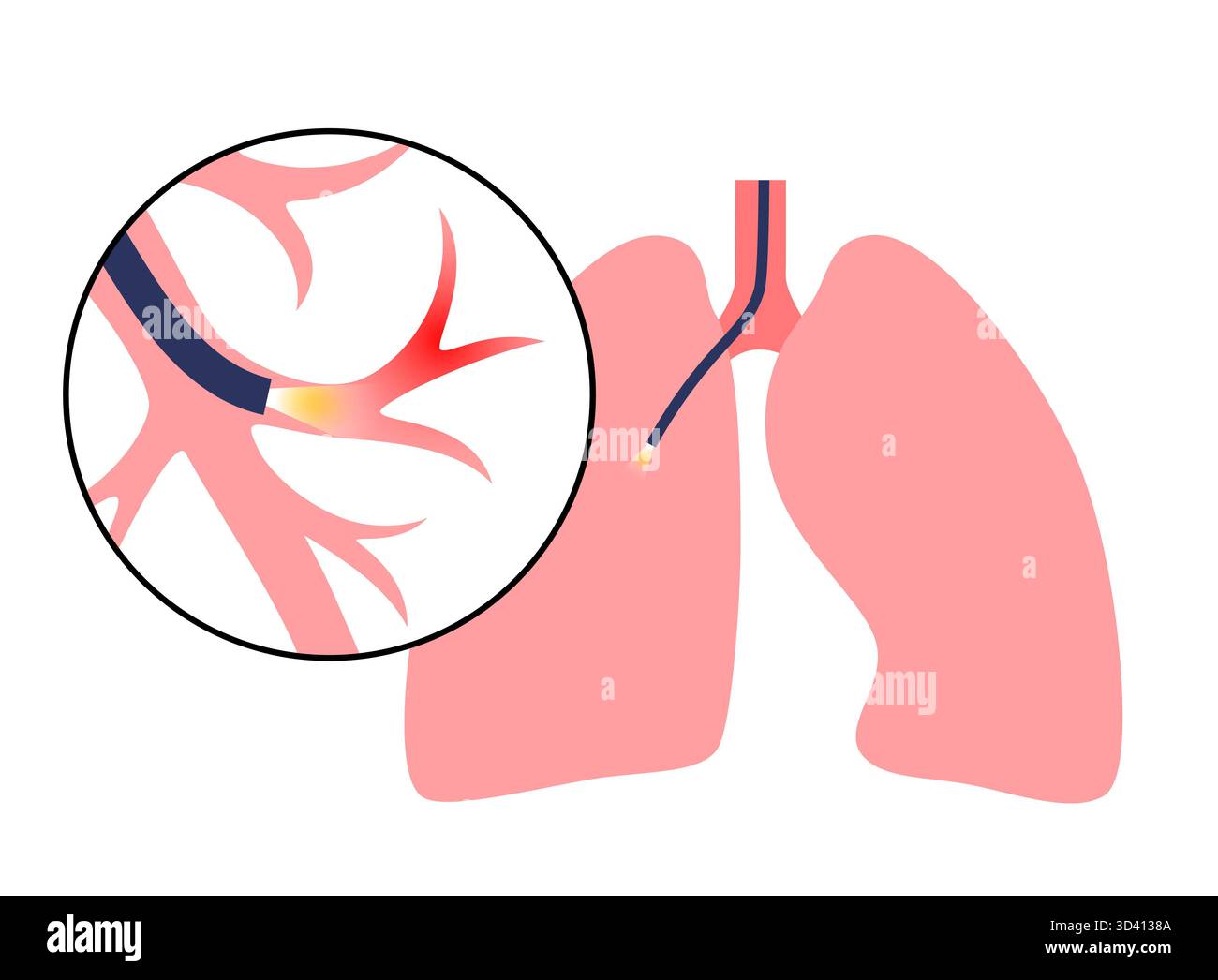 Illustrazione di una procedura broncoscopica. Ciò comporta l'inserimento di un tubo lungo, sottile e flessibile chiamato broncoscopio attraverso il naso o la bocca per esaminare il tubo del vento e le vie aeree. Viene utilizzato per diagnosticare le condizioni polmonari fornendo una visione chiara del rivestimento polmonare e consentire il prelievo di campioni di tessuto o fluido per analisi di laboratorio. Foto Stock