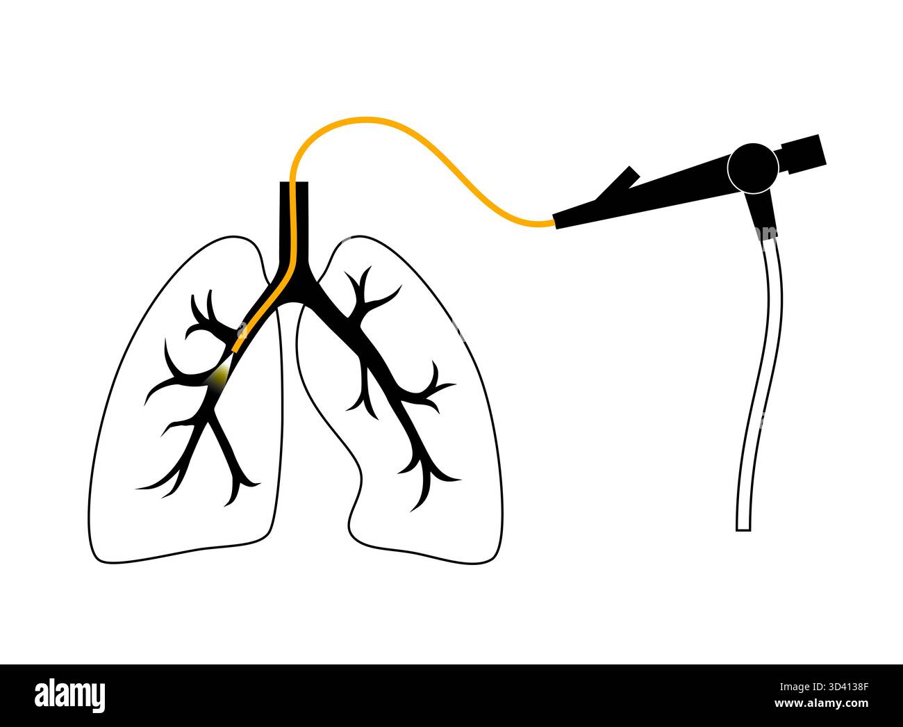 Illustrazione di una procedura broncoscopica. Ciò comporta l'inserimento di un tubo lungo, sottile e flessibile chiamato broncoscopio attraverso il naso o la bocca per esaminare il tubo del vento e le vie aeree. Viene utilizzato per diagnosticare le condizioni polmonari fornendo una visione chiara del rivestimento polmonare e consentire il prelievo di campioni di tessuto o fluido per analisi di laboratorio. Foto Stock