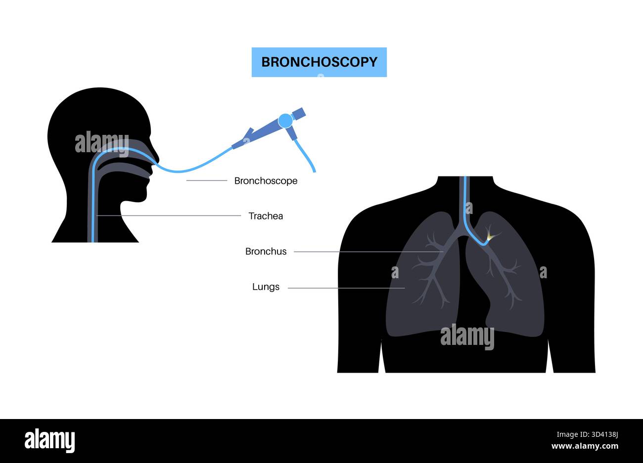 Illustrazione di una procedura broncoscopica. Ciò comporta l'inserimento di un tubo lungo, sottile e flessibile chiamato broncoscopio attraverso il naso o la bocca per esaminare il tubo del vento e le vie aeree. Viene utilizzato per diagnosticare le condizioni polmonari fornendo una visione chiara del rivestimento polmonare e consentire il prelievo di campioni di tessuto o fluido per analisi di laboratorio. Foto Stock