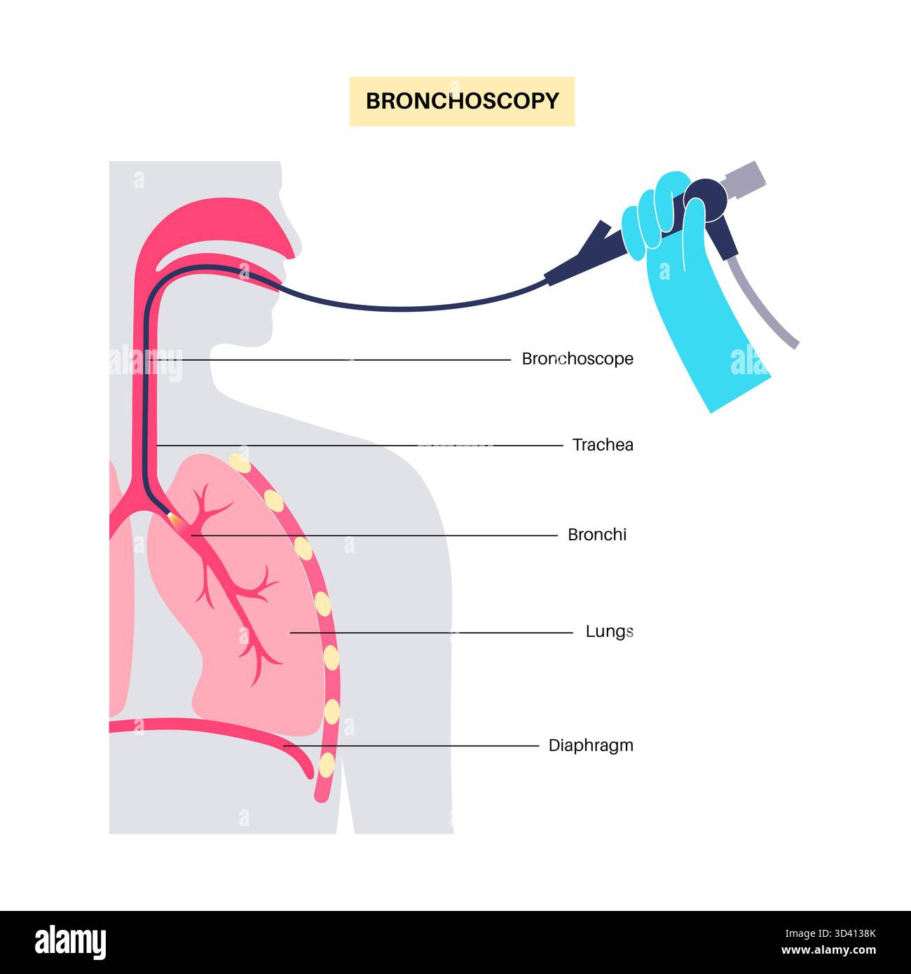 Illustrazione di una procedura broncoscopica. Ciò comporta l'inserimento di un tubo lungo, sottile e flessibile chiamato broncoscopio attraverso il naso o la bocca per esaminare il tubo del vento e le vie aeree. Viene utilizzato per diagnosticare le condizioni polmonari fornendo una visione chiara del rivestimento polmonare e consentire il prelievo di campioni di tessuto o fluido per analisi di laboratorio. Foto Stock