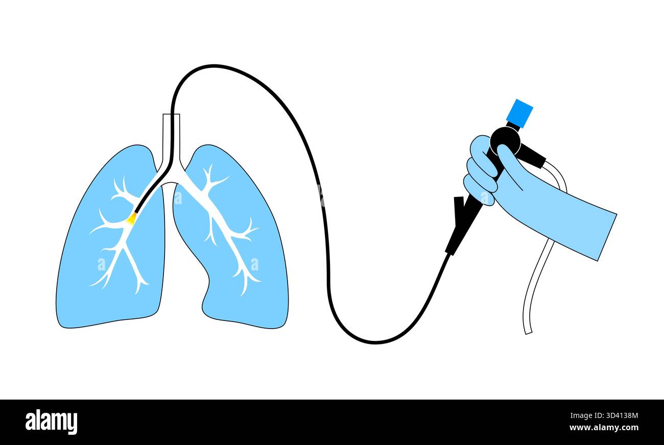 Illustrazione di una procedura broncoscopica. Ciò comporta l'inserimento di un tubo lungo, sottile e flessibile chiamato broncoscopio attraverso il naso o la bocca per esaminare il tubo del vento e le vie aeree. Viene utilizzato per diagnosticare le condizioni polmonari fornendo una visione chiara del rivestimento polmonare e consentire il prelievo di campioni di tessuto o fluido per analisi di laboratorio. Foto Stock
