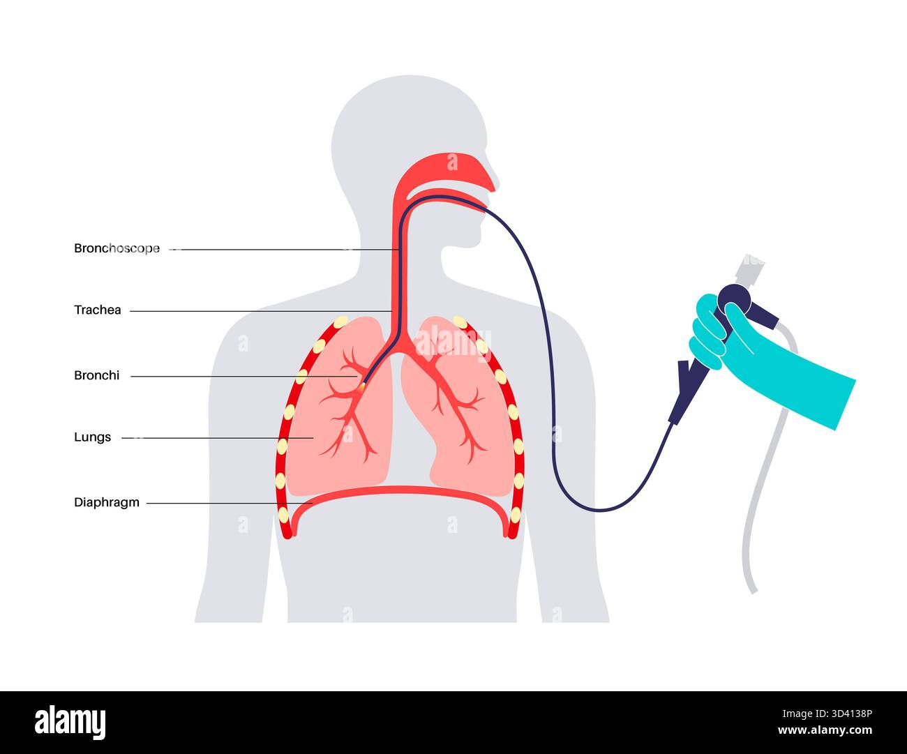 Illustrazione di una procedura broncoscopica. Ciò comporta l'inserimento di un tubo lungo, sottile e flessibile chiamato broncoscopio attraverso il naso o la bocca per esaminare il tubo del vento e le vie aeree. Viene utilizzato per diagnosticare le condizioni polmonari fornendo una visione chiara del rivestimento polmonare e consentire il prelievo di campioni di tessuto o fluido per analisi di laboratorio. Foto Stock