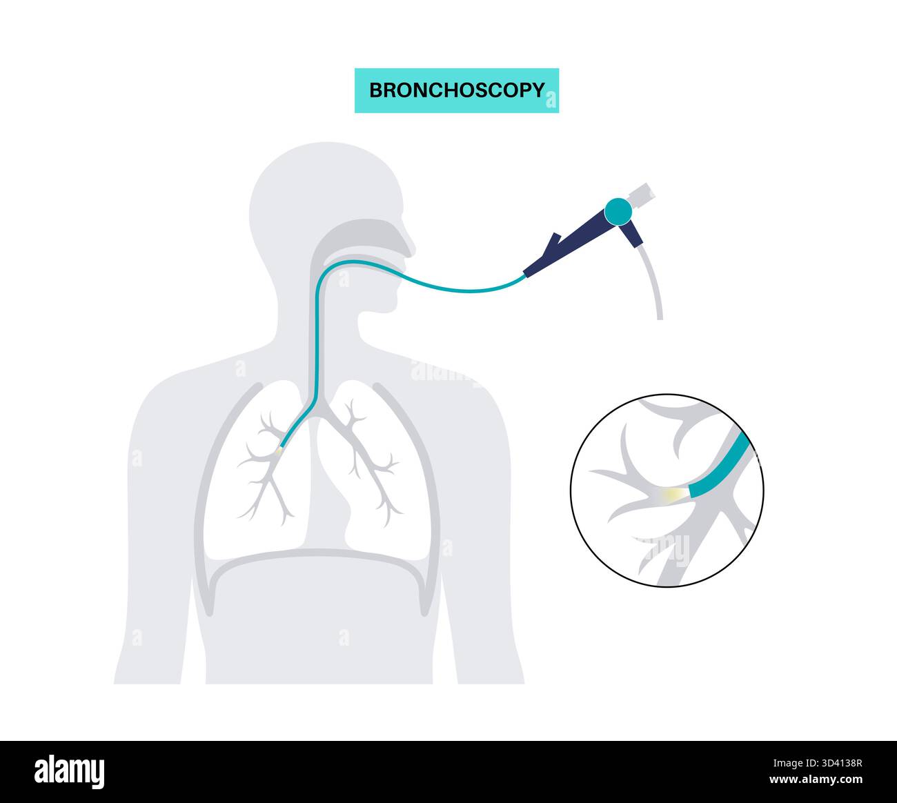 Illustrazione di una procedura broncoscopica. Ciò comporta l'inserimento di un tubo lungo, sottile e flessibile chiamato broncoscopio attraverso il naso o la bocca per esaminare il tubo del vento e le vie aeree. Viene utilizzato per diagnosticare le condizioni polmonari fornendo una visione chiara del rivestimento polmonare e consentire il prelievo di campioni di tessuto o fluido per analisi di laboratorio. Foto Stock