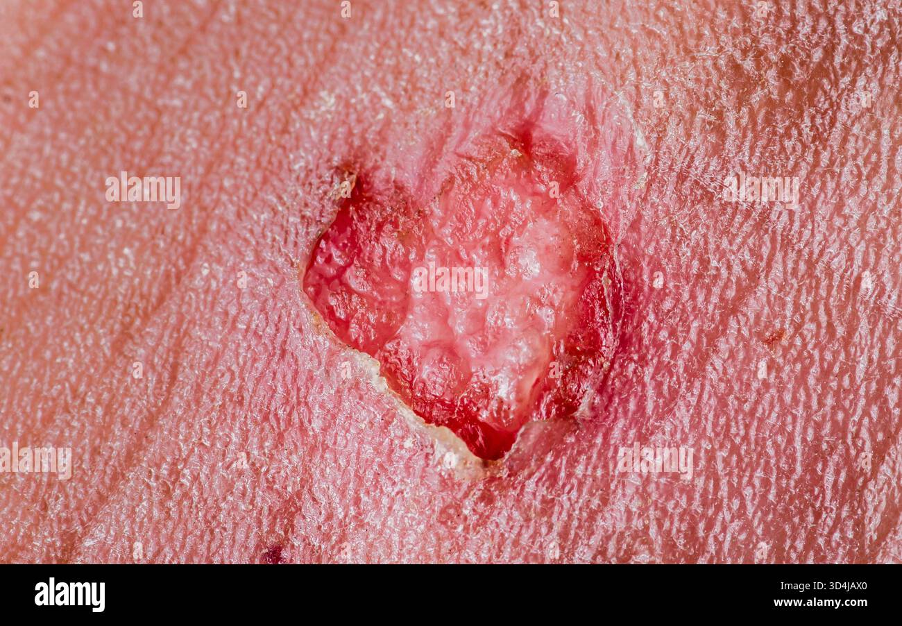 Primo piano del carcinoma a cellule basali sulla pelle del viso che mostra una lesione ulcerata e irregolare con crosta e degradazione dei tessuti indicativa di CA cutanea comune Foto Stock