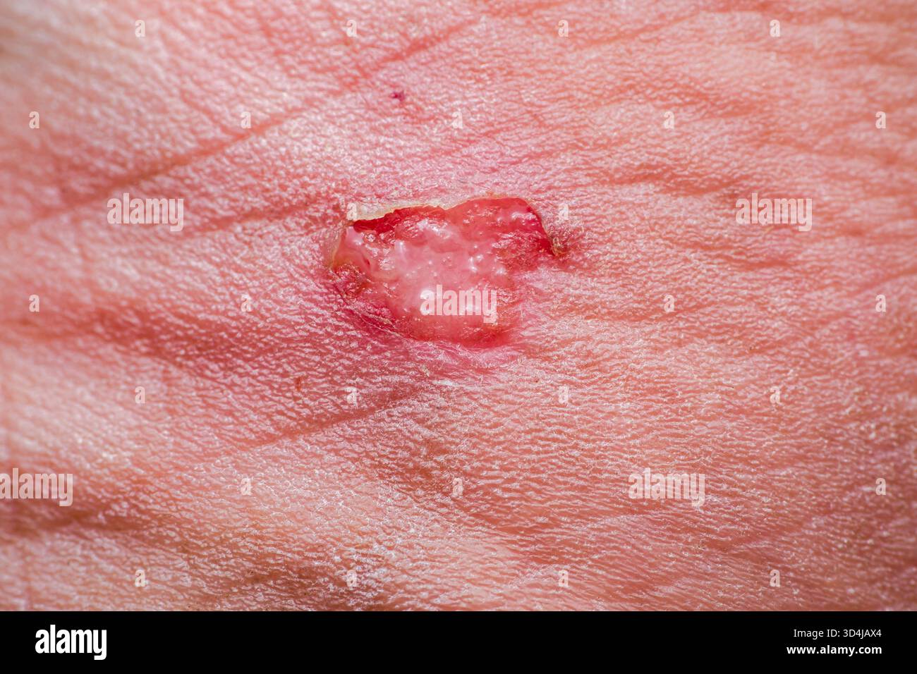 Pelle umana con una ferita di vescicole aperta che mostra la base grezza rossa e vescicole piene di liquido, dettaglio di un dolore, infiammato lesione nel processo di Foto Stock