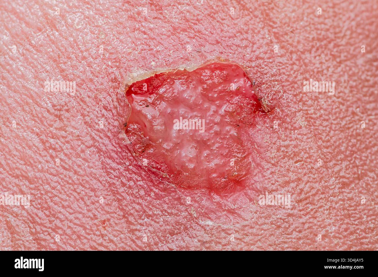Pelle umana che presenta una ferita profonda da abrasione o ustione con il derma esposto e forma un fluido simile a blister, indicando le fasi iniziali della repa tissutale Foto Stock