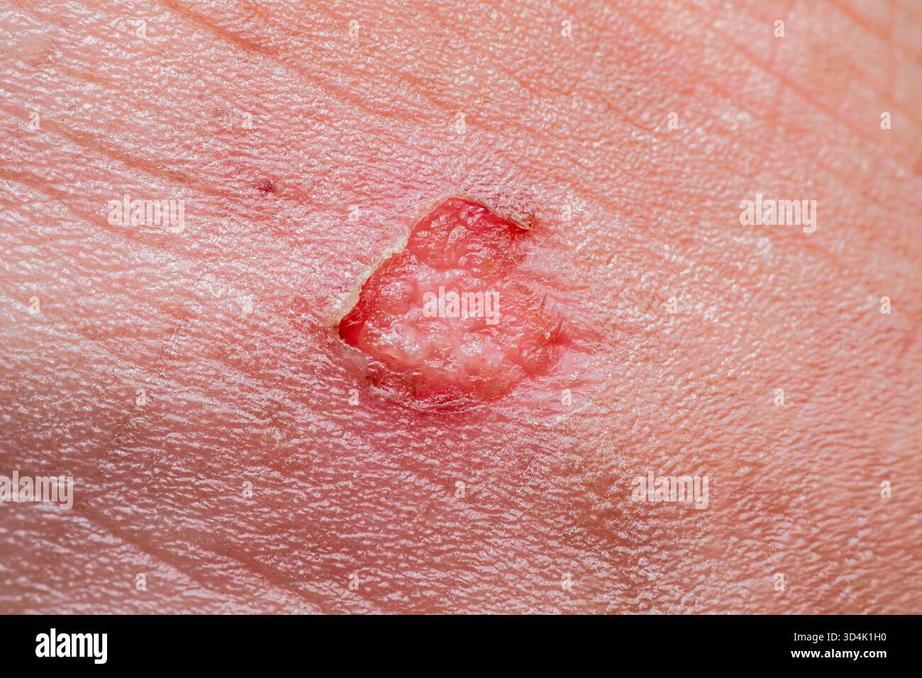 Primo piano di pelle umana con una piccola ferita di guarigione rossa che mostra nuova formazione di tessuto, infiammazione e epidermide rigenerante per medico, dermatologia A. Foto Stock