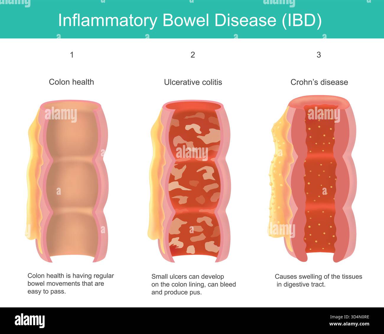 Malattia infiammatoria intestinale (IBD). Questo diagramma illustra le differenze tra un colon sano e i due principali tipi di Diseas intestinale infiammatorio Illustrazione Vettoriale