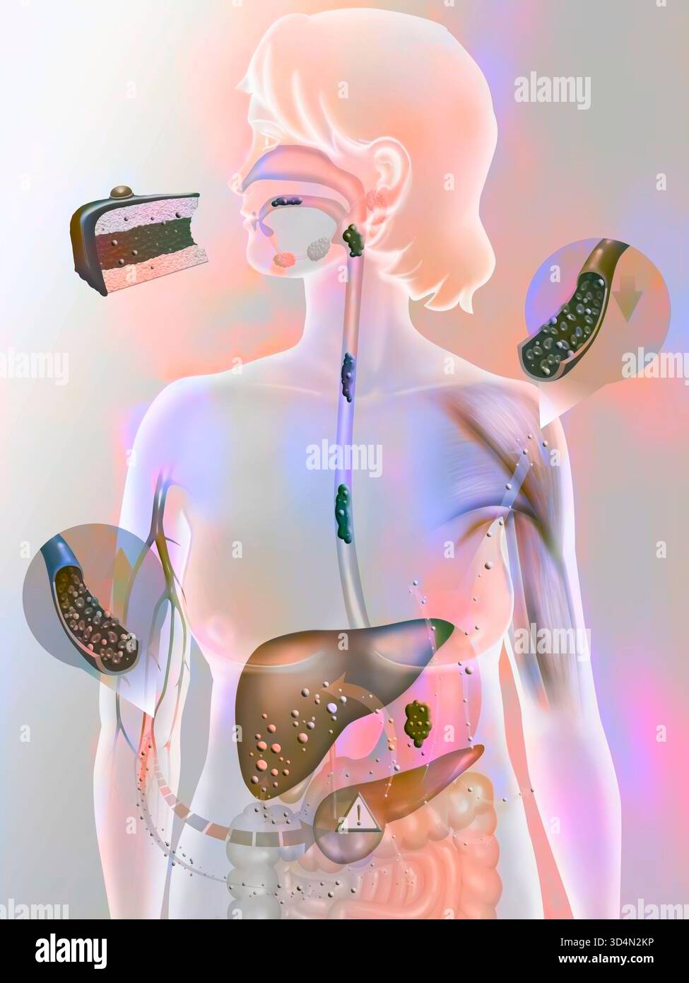 Secrezione di insulina in una persona con diabete di tipo 2. Foto Stock