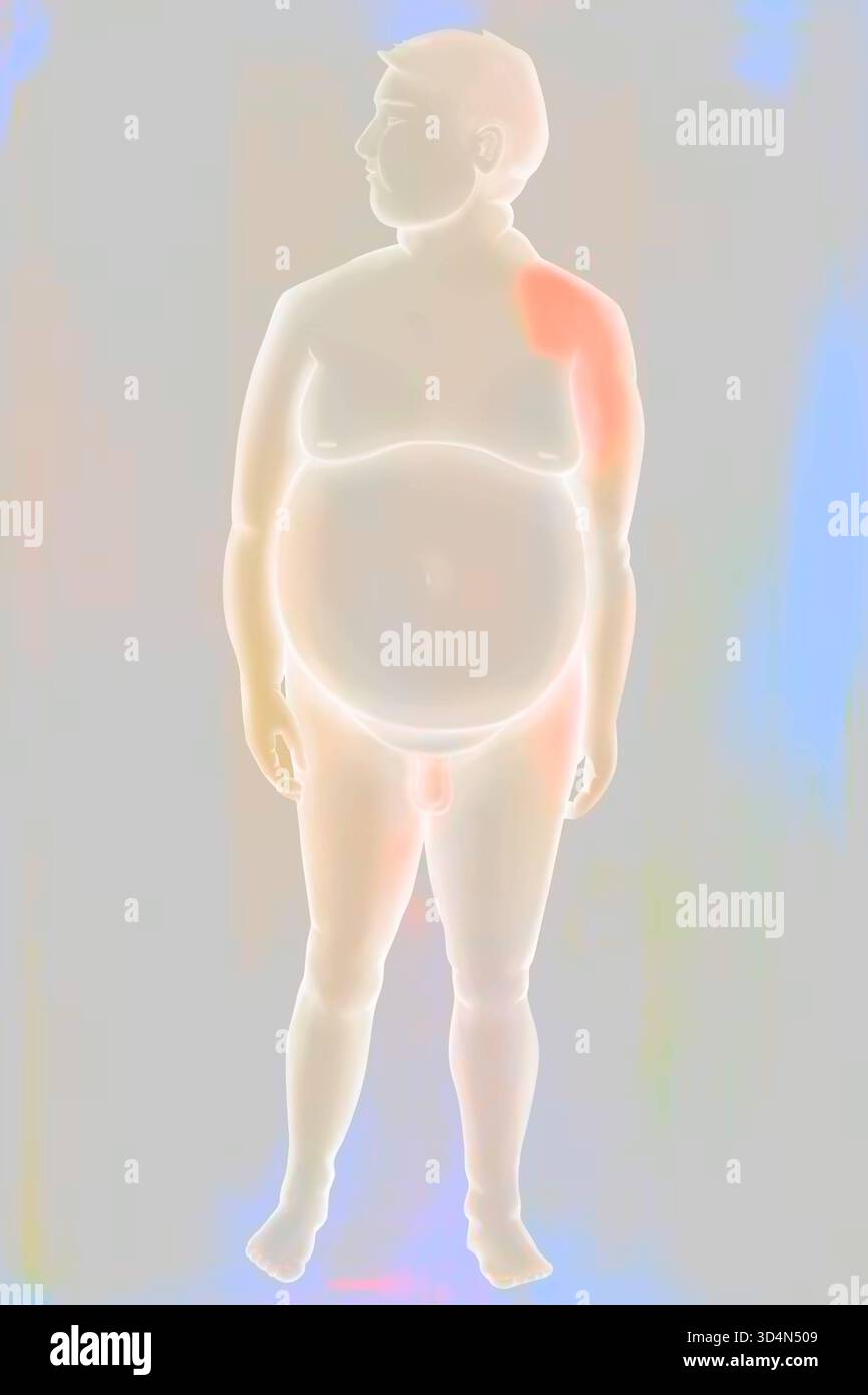Uomo obeso. Ci sono tre tipi di obesità: Obesità androide solo addome, più comune negli uomini, obesità gineidea solo pelvi e cosce, più comune in W Foto Stock