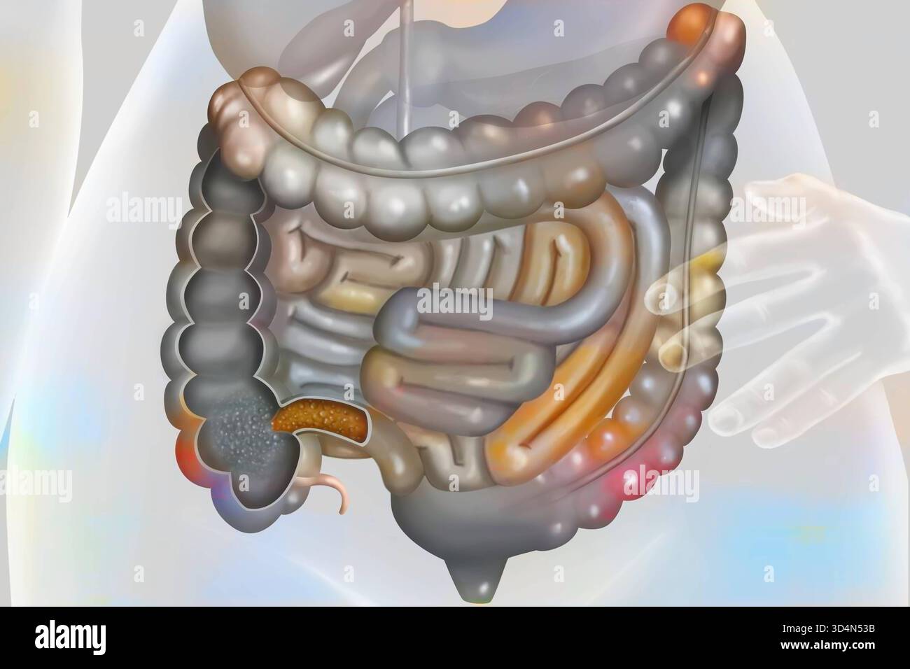 Morbo di Crohn. Il morbo di Crohn è un'infiammazione cronica del tratto digerente, che colpisce principalmente l'ileo, il colon e l'ano. È accompagnato da de Foto Stock