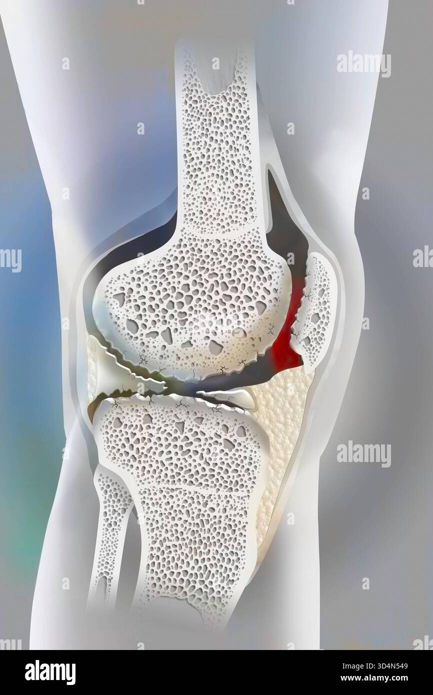 Osteoartrite gonartrosi del ginocchio. L'osteoartrite può influenzare una o più articolazioni del ginocchio. Si tratta di osteoartrite globale con coinvolgimento dell'inte Foto Stock
