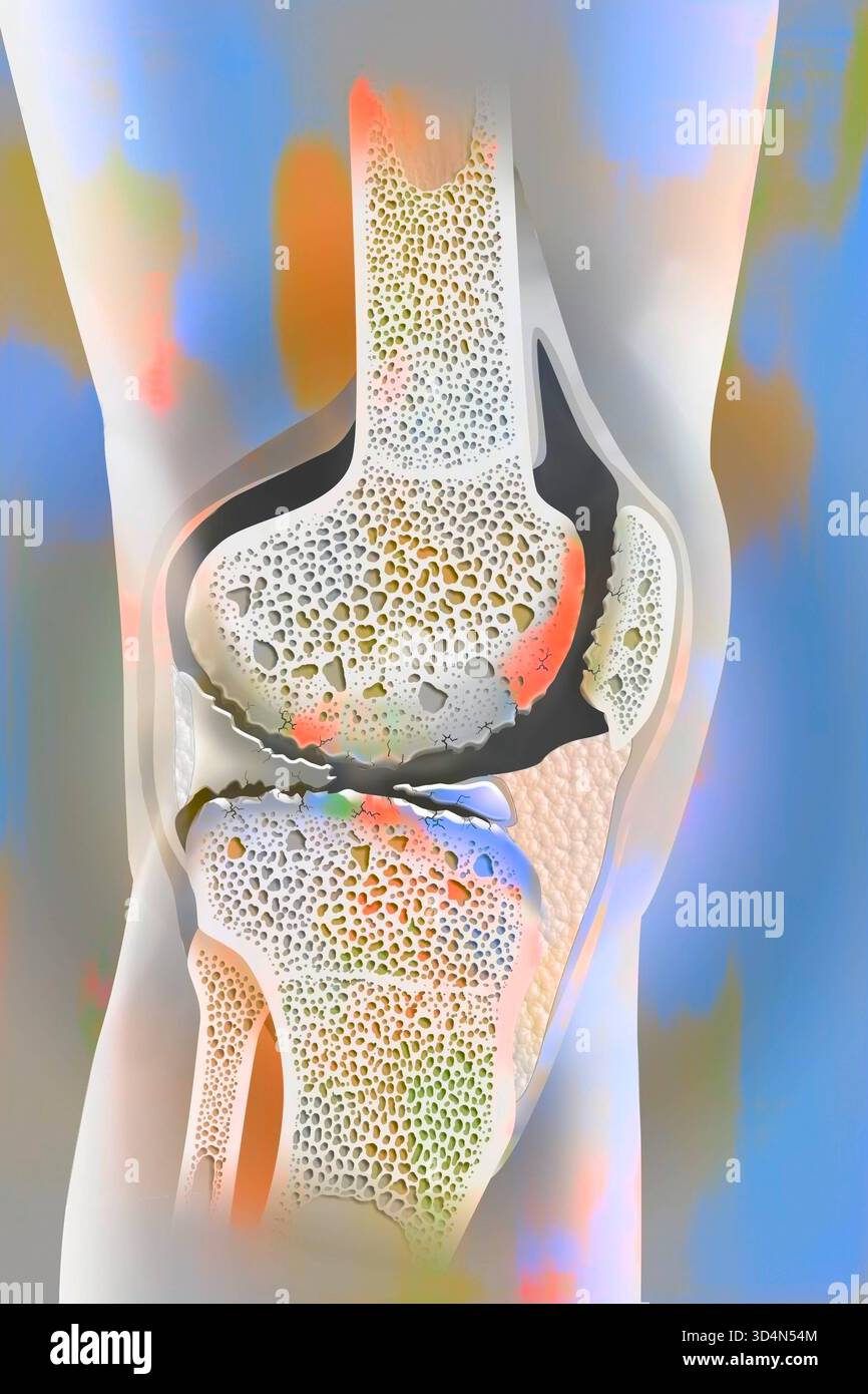 Osteoartrite gonartrosi del ginocchio. L'osteoartrite può influenzare una o più articolazioni del ginocchio. Si tratta di osteoartrite globale con coinvolgimento dell'inte Foto Stock