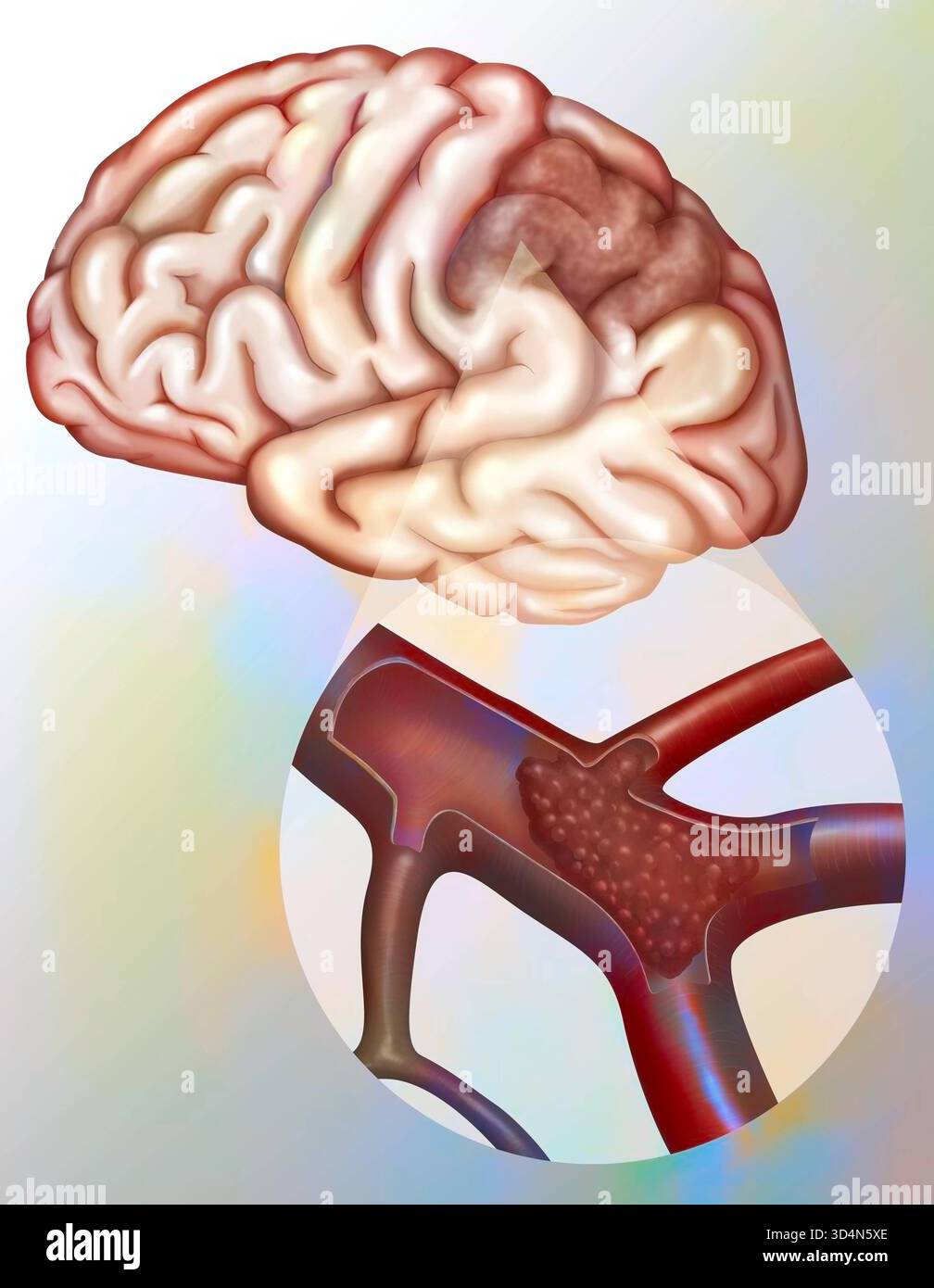 Trombosi dell'arteria cerebrale. Trombosi cerebrale ostruzione di un'arteria cerebrale causata da un trombo o da un'embolia cerebrale ostruzione di un'arteria cerebrale b Foto Stock