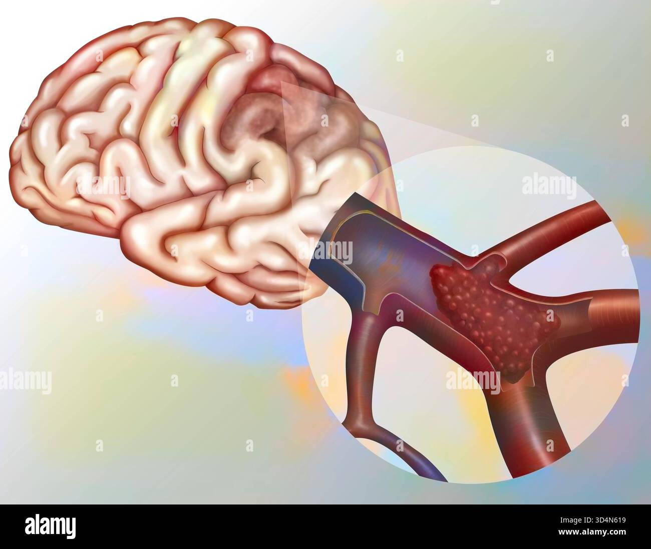 Trombosi dell'arteria cerebrale. Trombosi cerebrale ostruzione di un'arteria cerebrale causata da un trombo o da un'embolia cerebrale ostruzione di un'arteria cerebrale b Foto Stock