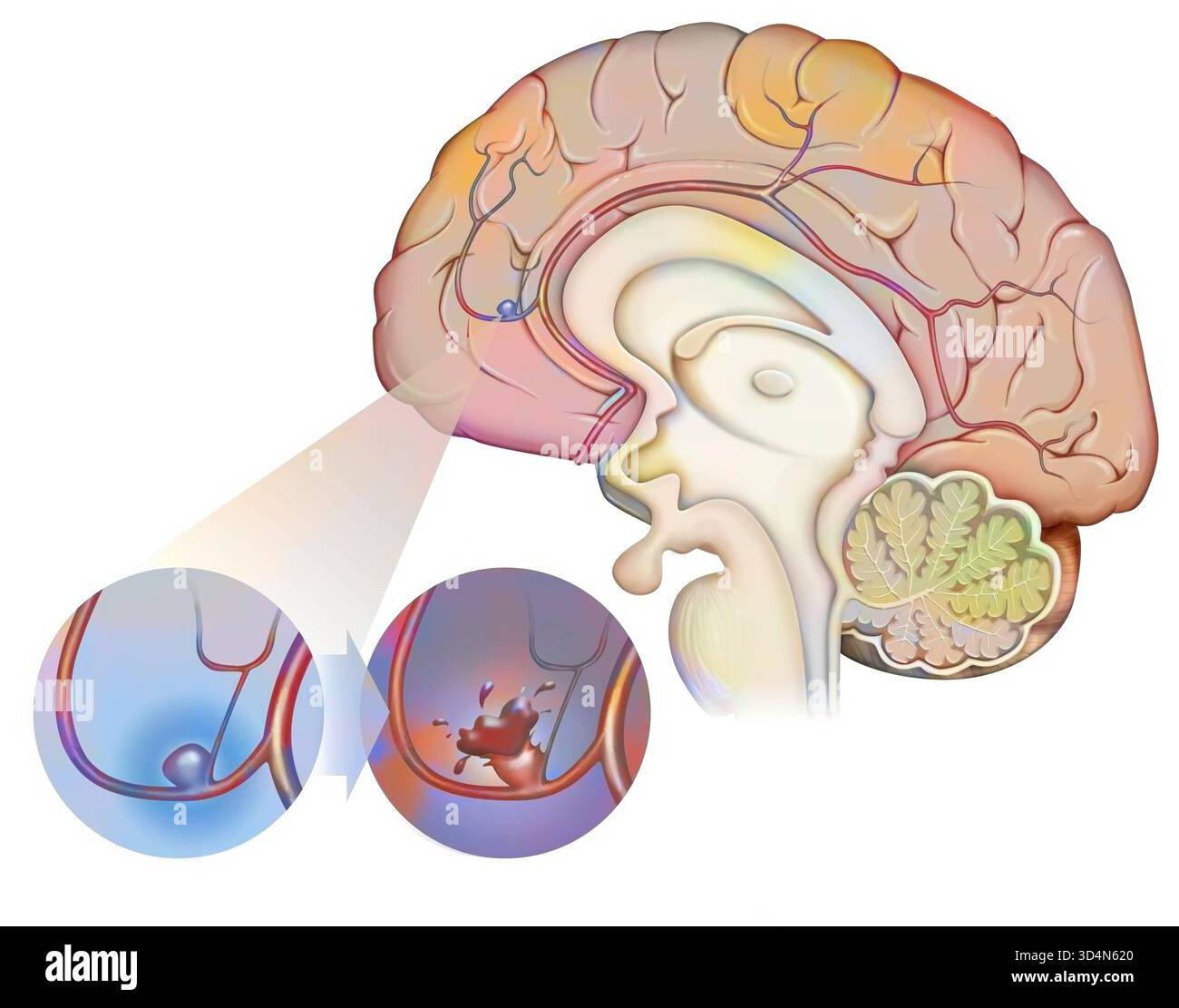 Formazione e rottura di un aneurisma dell'arteria cerebrale, con conseguente ictus. Aneurisma cerebrale 016240 153 Foto Stock