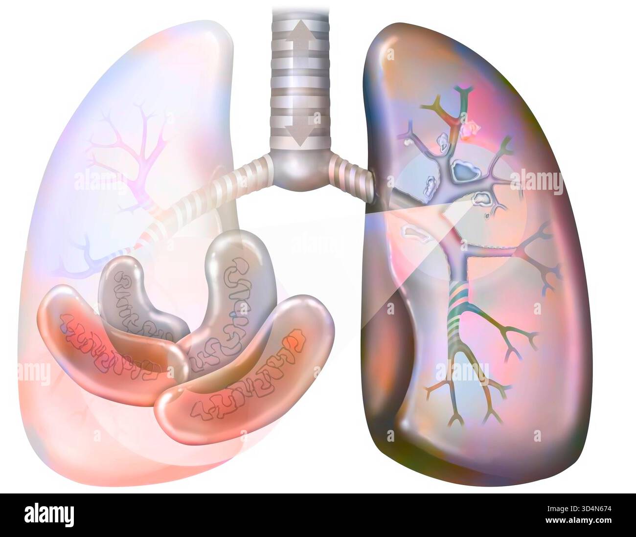 Tubercolosi polmonare. I bacilli di Koch colonizzano i polmoni e si sviluppano, distruggendo i tessuti, formando foci caseum. Questi foci calcificano, formando caverne, io Foto Stock