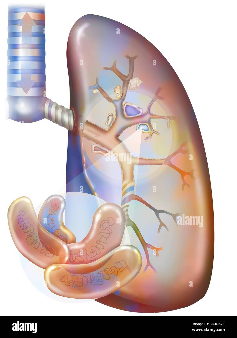 Tubercolosi polmonare. I bacilli di Koch colonizzano i polmoni e si sviluppano, distruggendo i tessuti, formando foci caseum. Questi foci calcificano, formando caverne, io Foto Stock