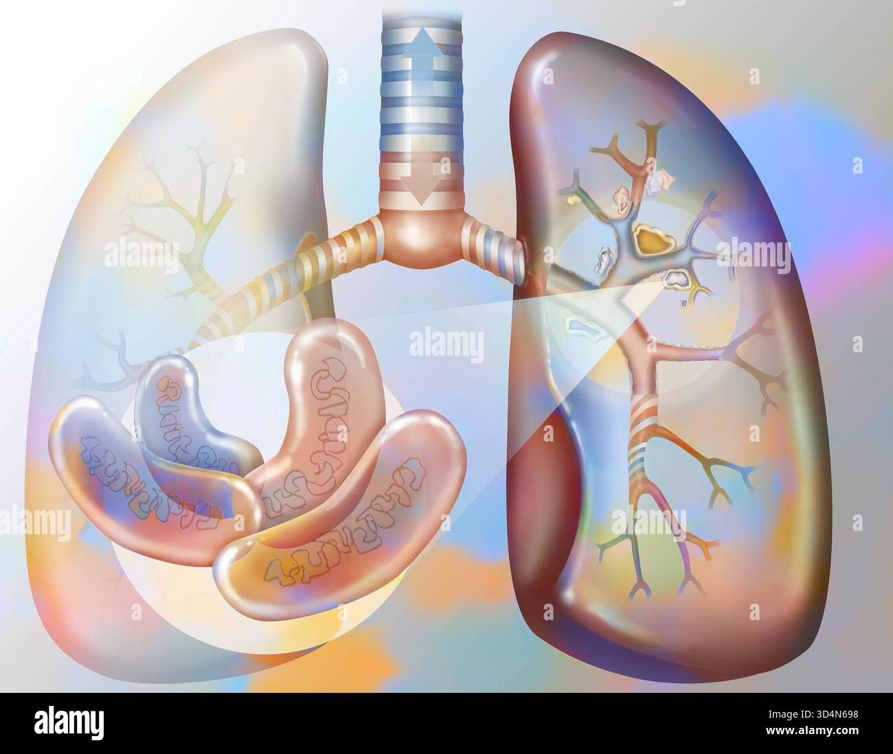 Tubercolosi polmonare. I bacilli di Koch colonizzano i polmoni e si sviluppano, distruggendo i tessuti, formando foci caseum. Questi foci calcificano, formando caverne, io Foto Stock