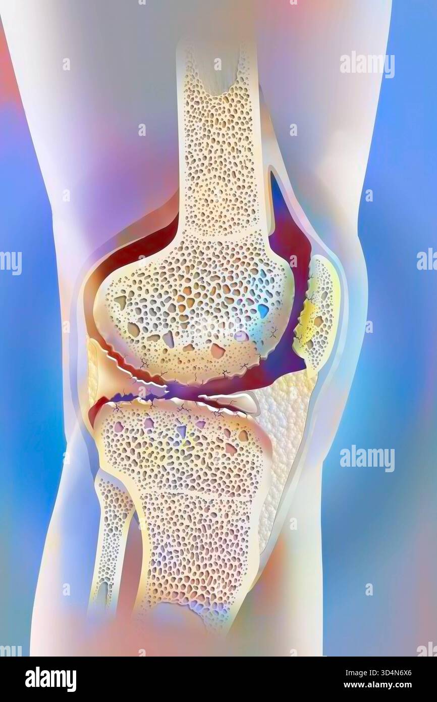 Osteoartrite gonartrosi del ginocchio. L'osteoartrite può influenzare una o più articolazioni del ginocchio. Si tratta di osteoartrite globale con coinvolgimento dell'inte Foto Stock