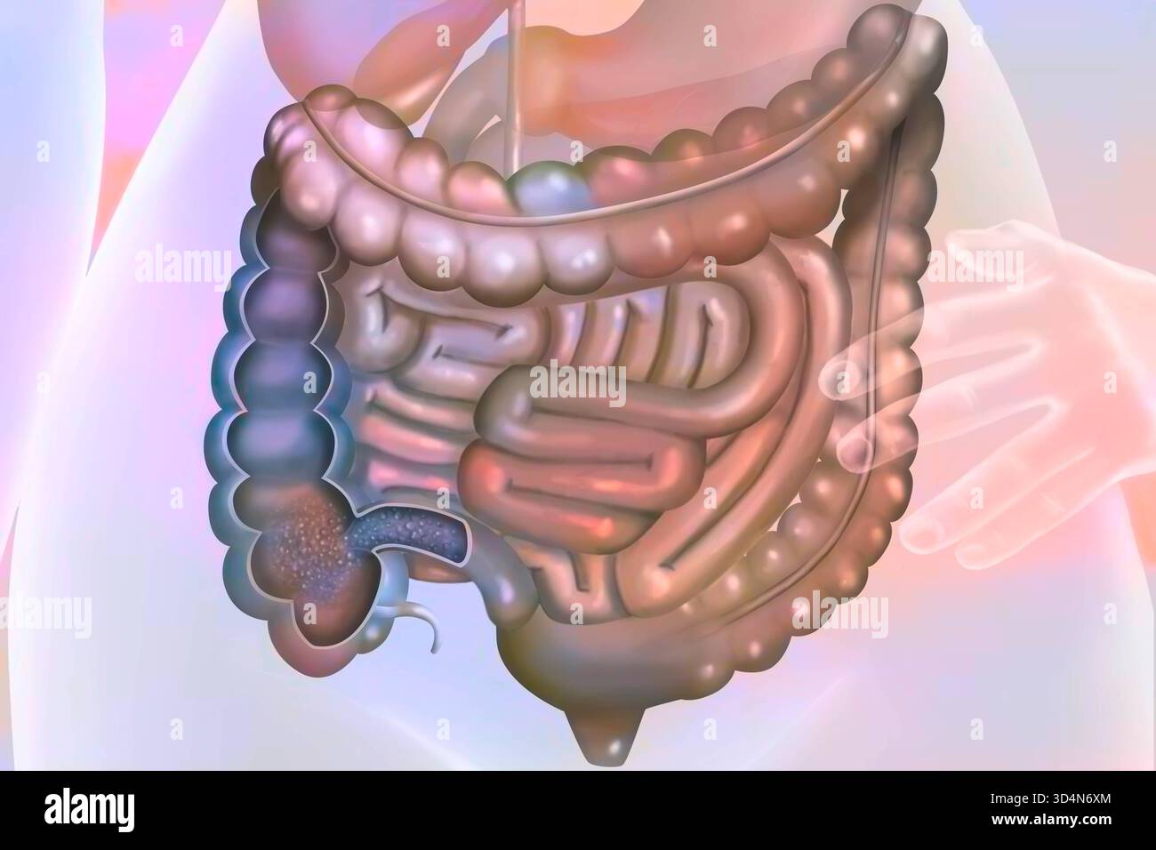 Morbo di Crohn. Il morbo di Crohn è un'infiammazione cronica del tratto digerente, che colpisce principalmente l'ileo, il colon e l'ano. È accompagnato da de Foto Stock