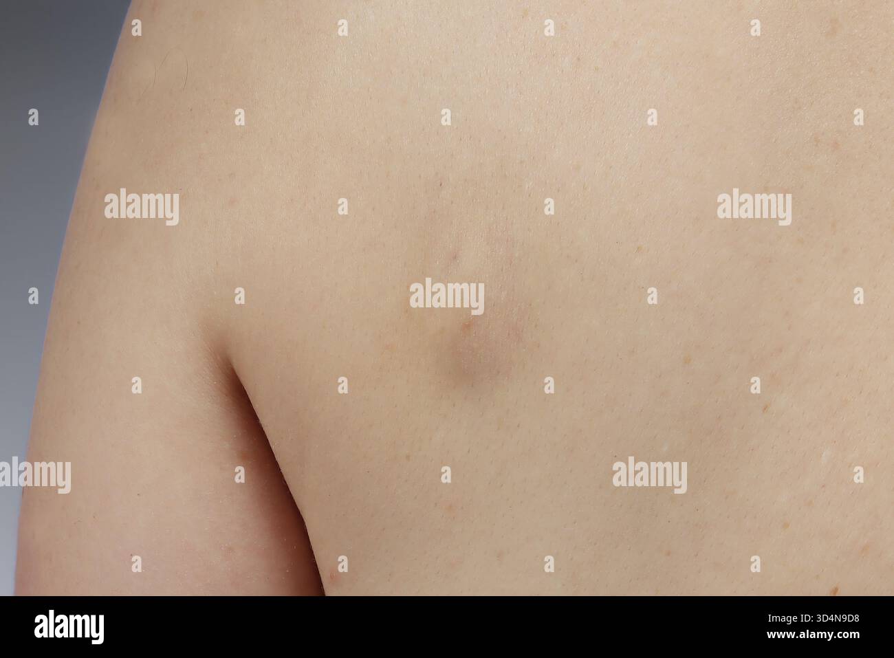 Cisti sebacea della schiena in una donna di 42 anni. Foto Stock