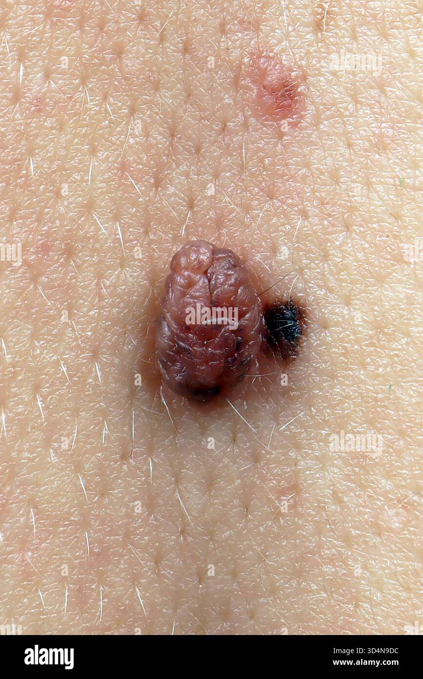 Nevo benigno della schiena in una donna di 44 anni. Foto Stock