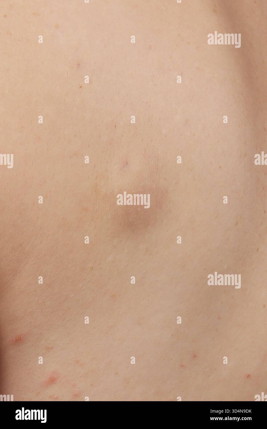 Cisti sebacea della schiena in una donna di 42 anni. Foto Stock