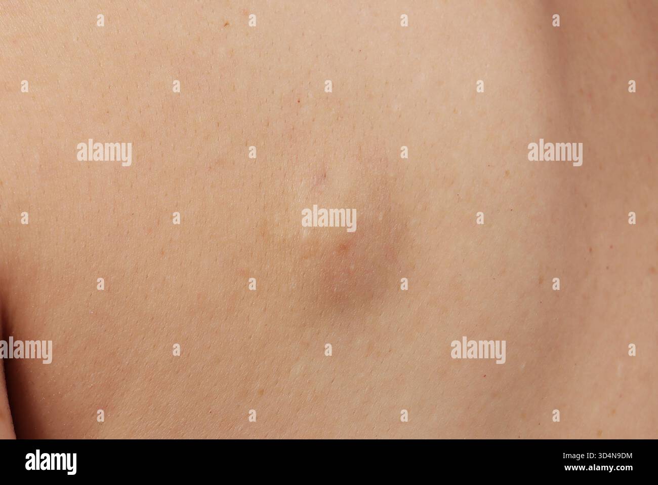 Cisti sebacea della schiena in una donna di 42 anni. Foto Stock