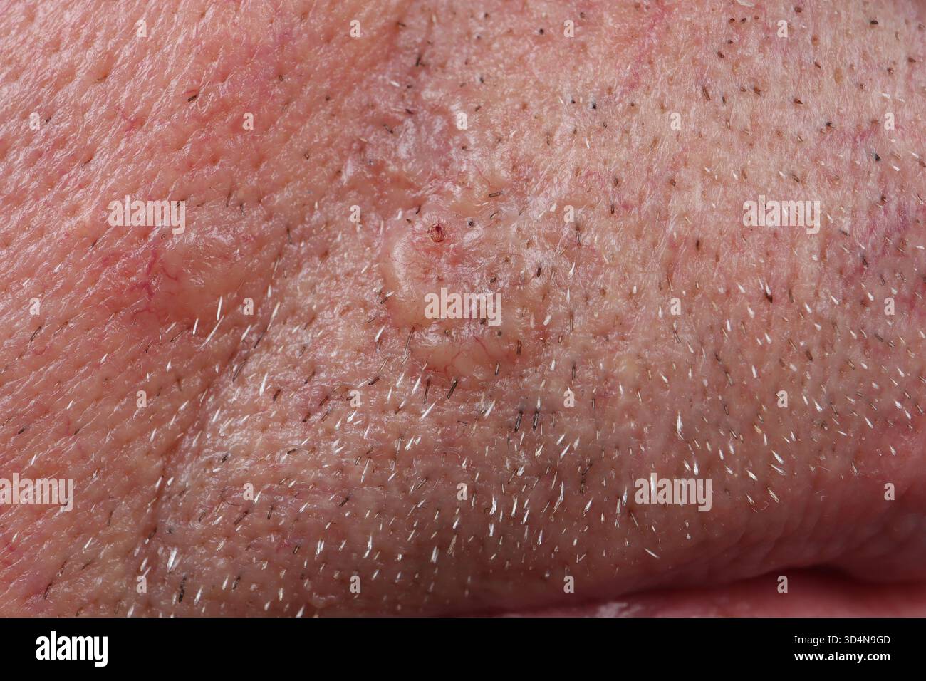 Carcinoma nodulare a cellule basali del labbro superiore in un uomo di 74 anni. Foto Stock