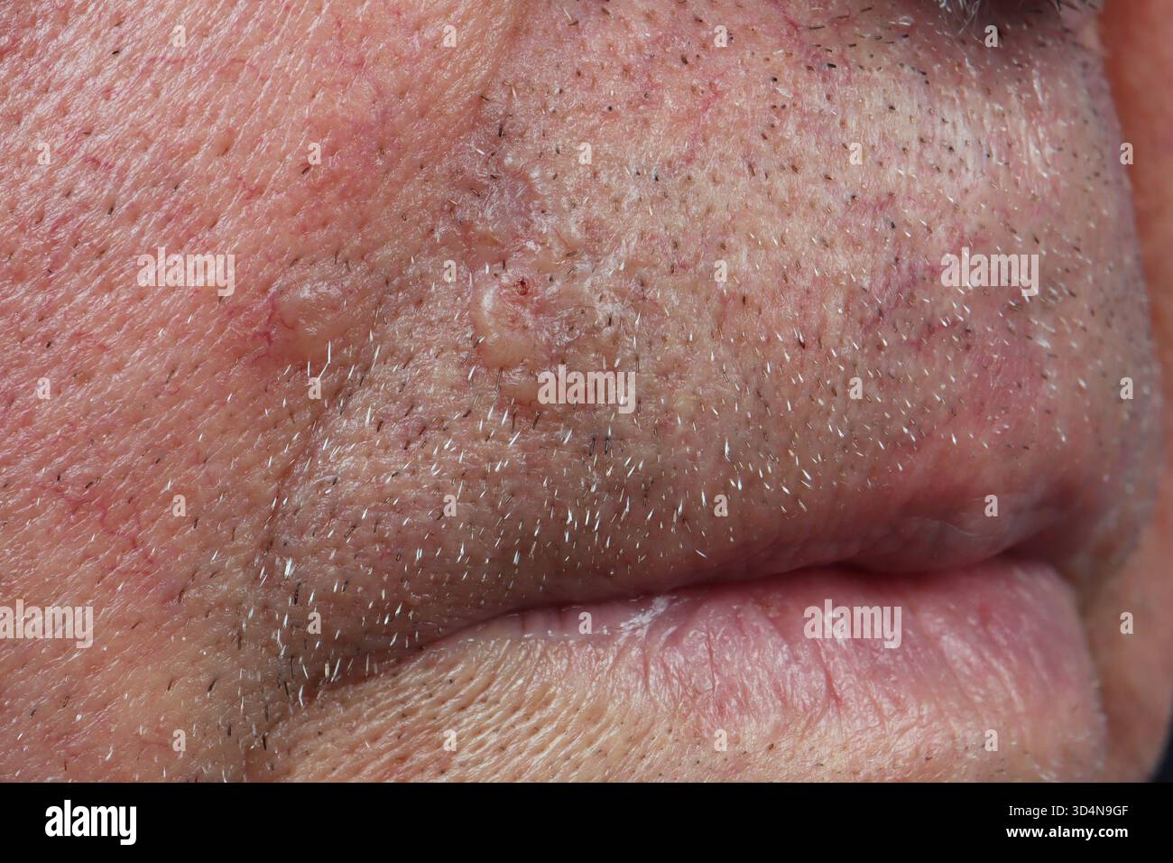 Carcinoma nodulare a cellule basali del labbro superiore in un uomo di 74 anni. Foto Stock
