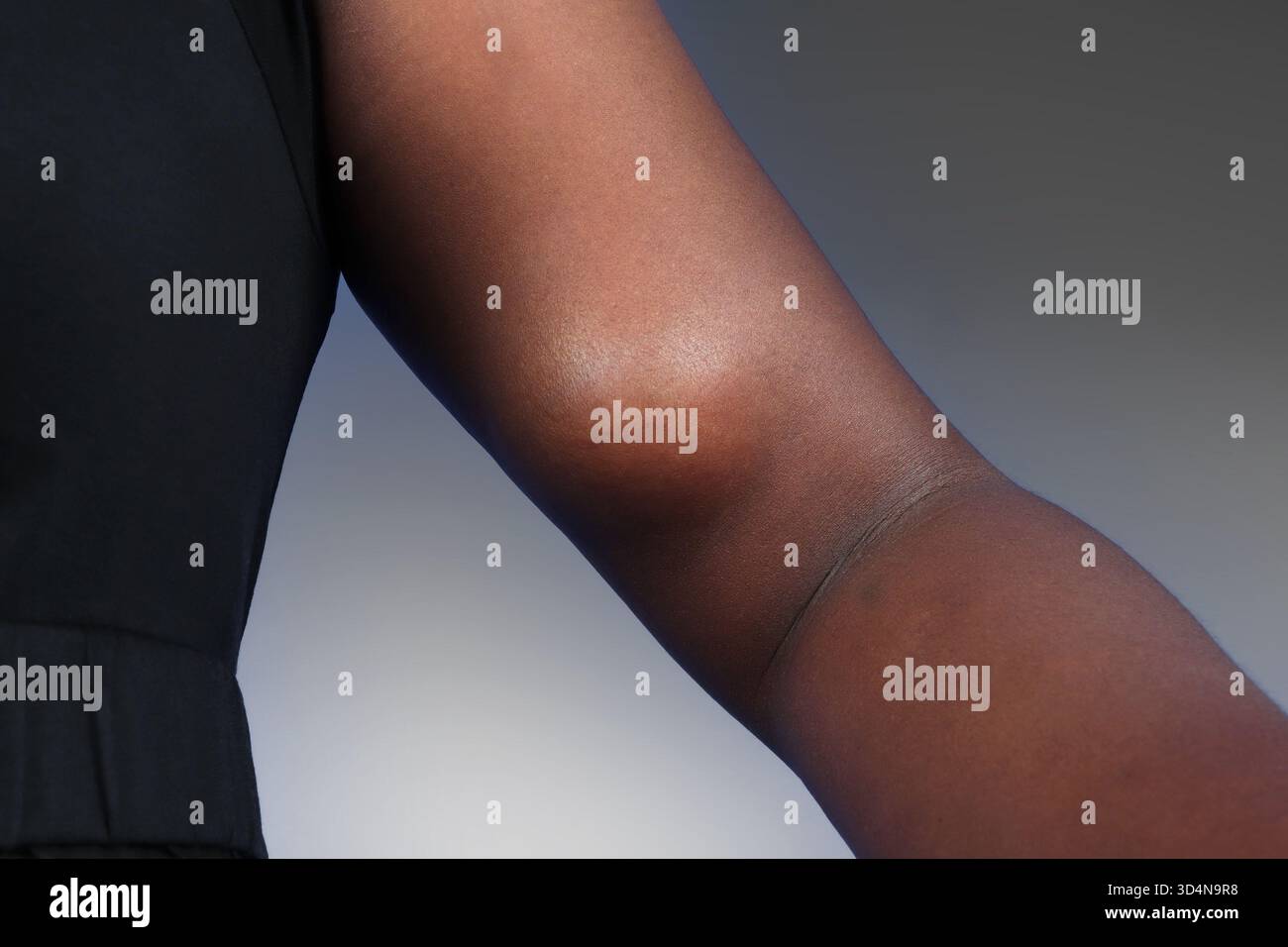 Lipoma benigno del braccio in una donna di 36 anni. Foto Stock