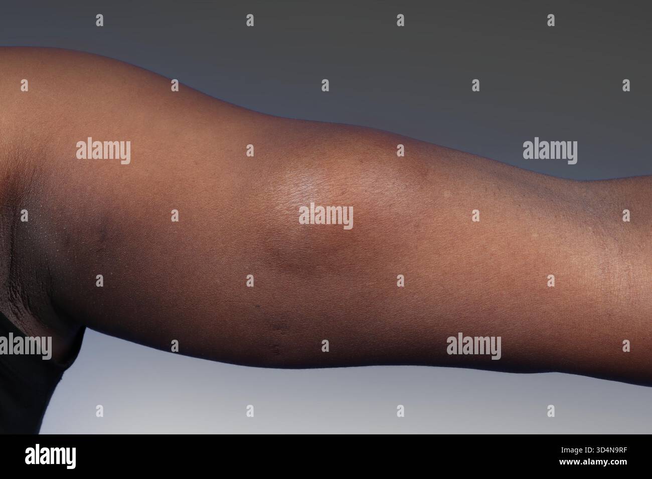 Lipoma benigno del braccio in una donna di 36 anni. Foto Stock