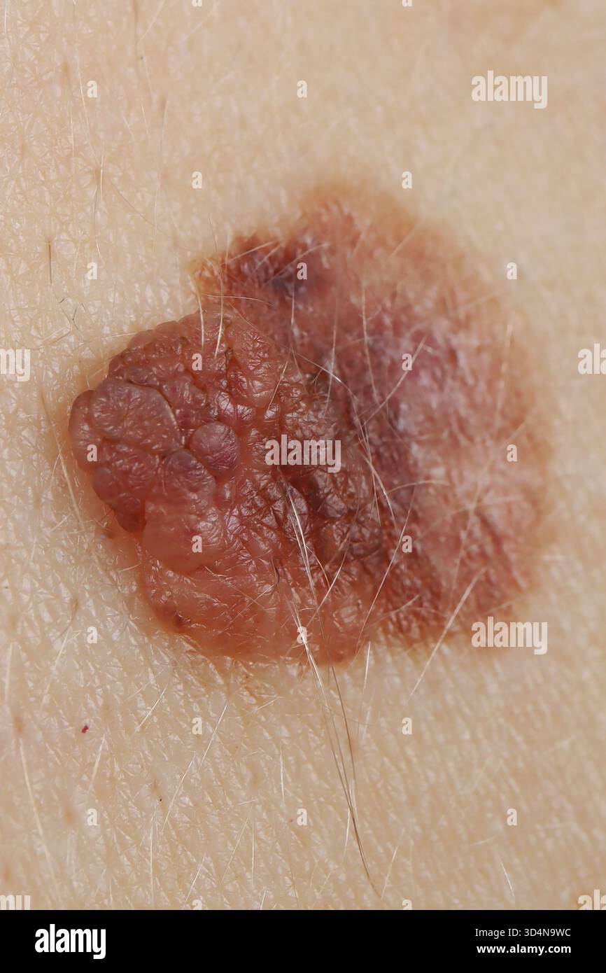 Melanoma superficiale della schiena in una donna di 32 anni. Foto Stock