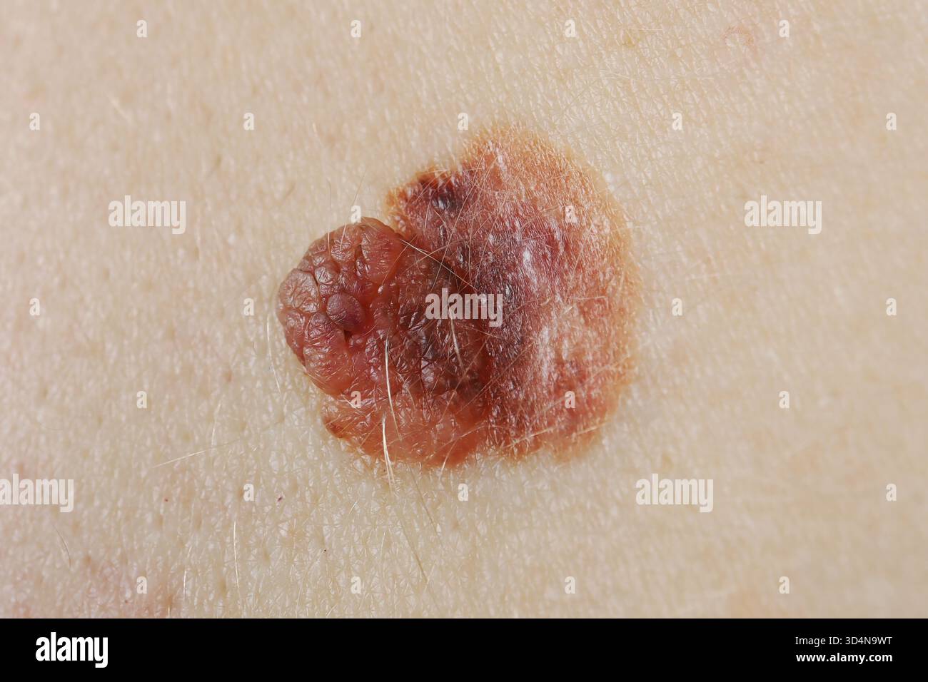 Melanoma superficiale della schiena in una donna di 32 anni. Foto Stock