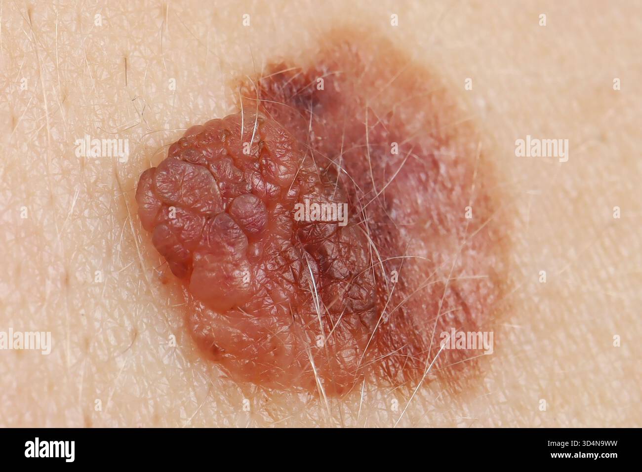 Melanoma superficiale della schiena in una donna di 32 anni. Foto Stock