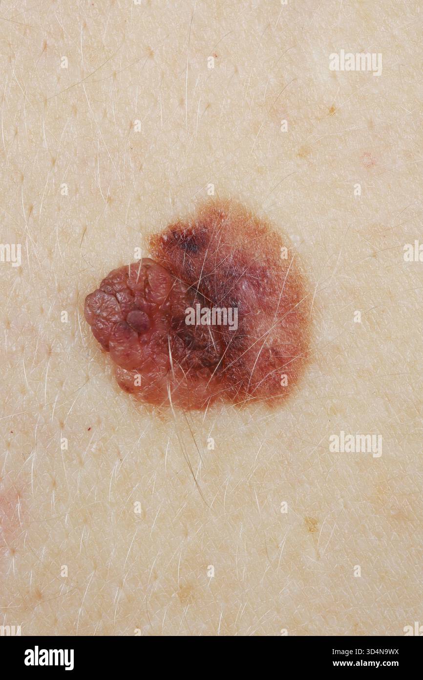 Melanoma superficiale della schiena in una donna di 32 anni. Foto Stock