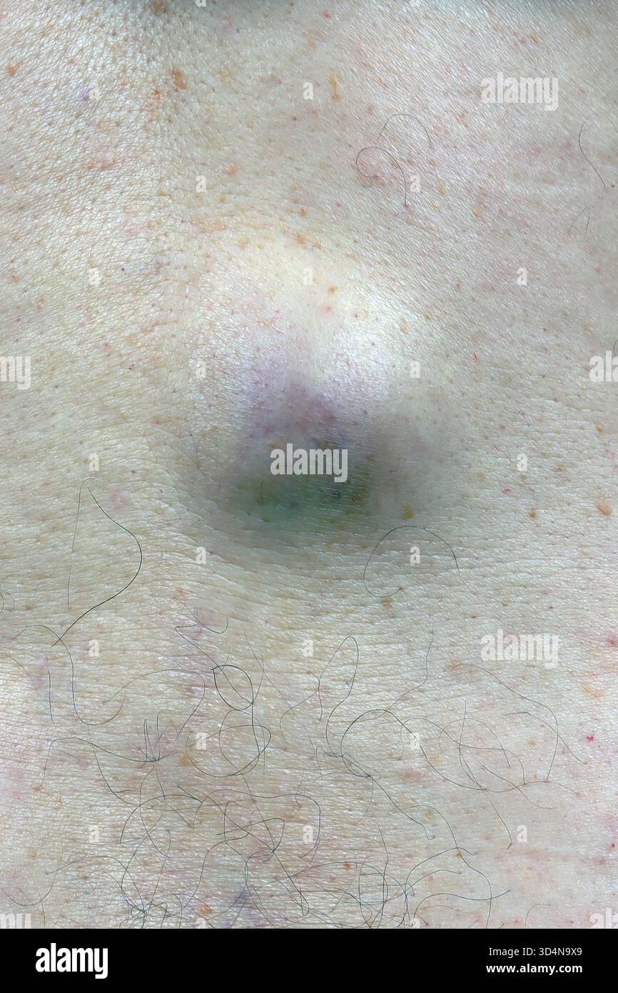 Cisti sebacea della schiena in un uomo di 71 anni. Foto Stock