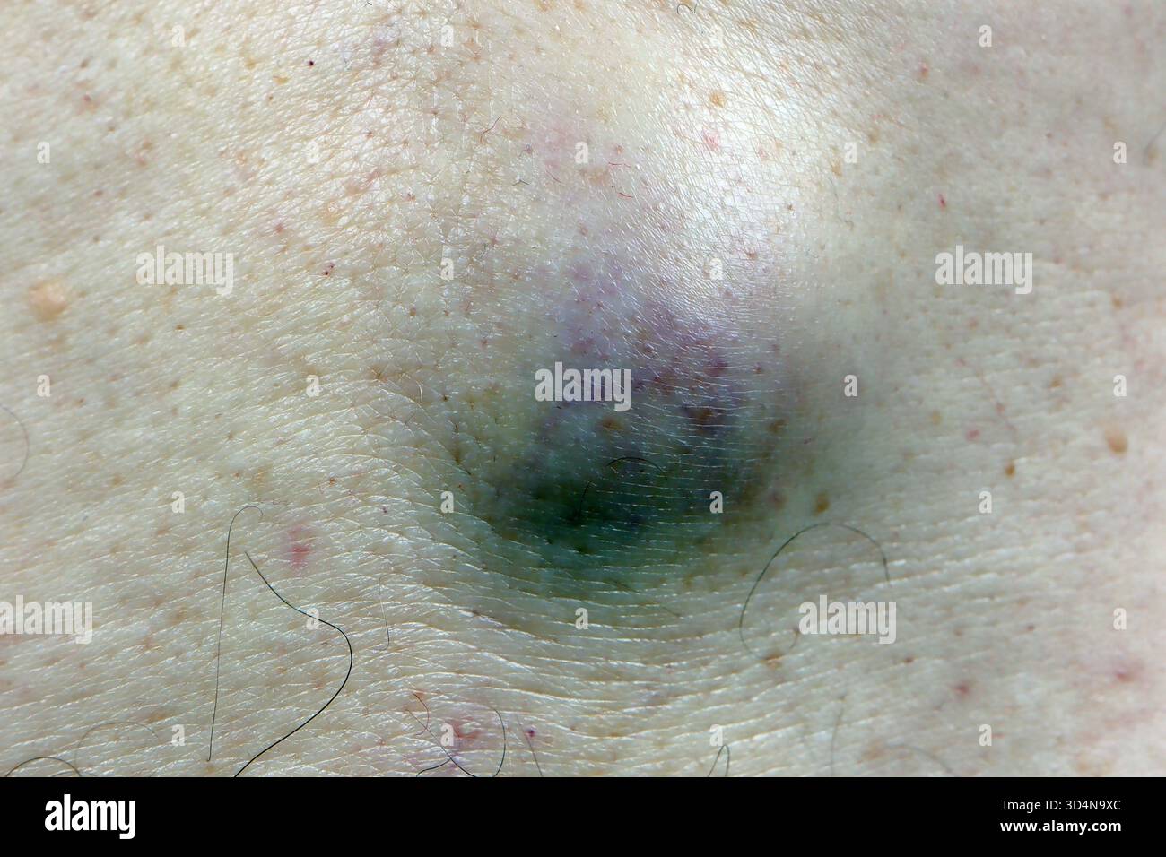 Cisti sebacea della schiena in un uomo di 71 anni. Foto Stock