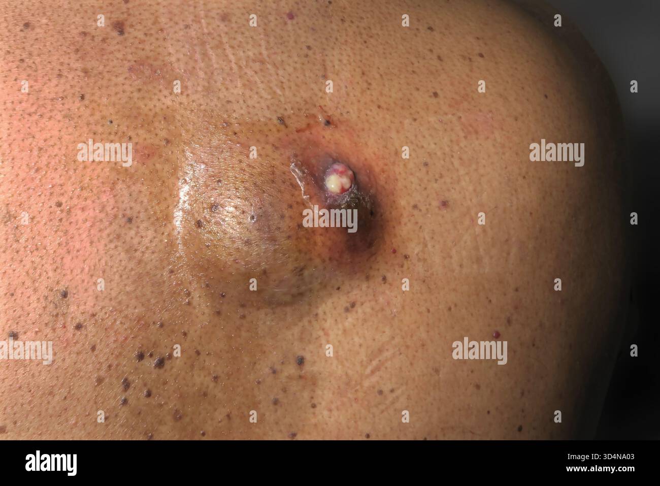 Cisti sebacea ulcerata della schiena in un uomo di 46 anni. Foto Stock