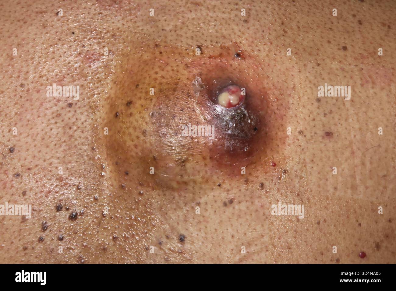 Cisti sebacea ulcerata della schiena in un uomo di 46 anni. Foto Stock