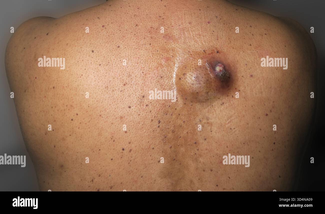 Cisti sebacea ulcerata della schiena in un uomo di 46 anni. Foto Stock