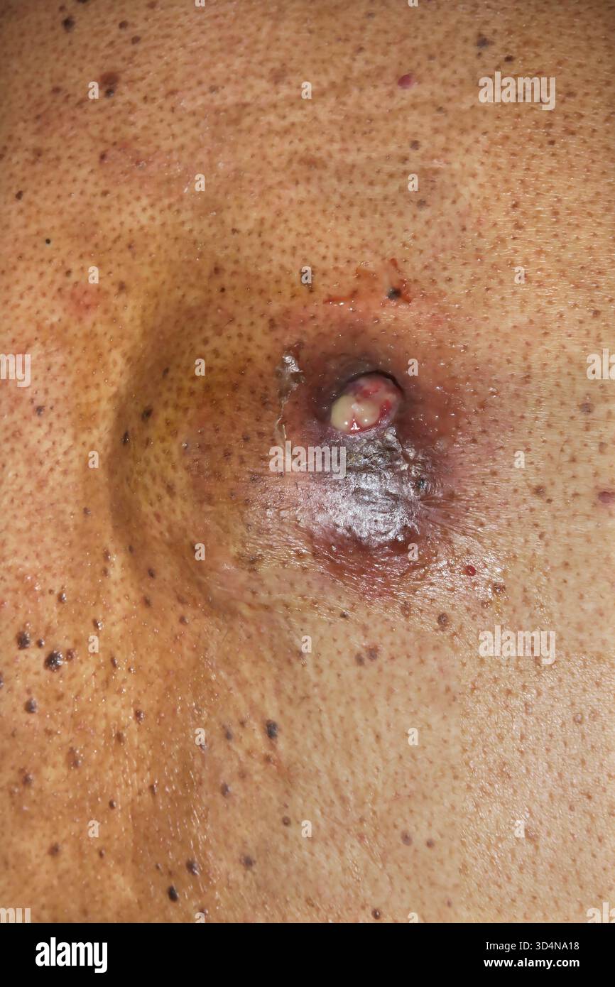 Cisti sebacea ulcerata della schiena in un uomo di 46 anni. Foto Stock