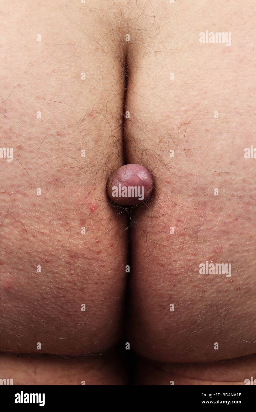Cisti di Trichilemmal della nata in un uomo di 45 anni. Foto Stock
